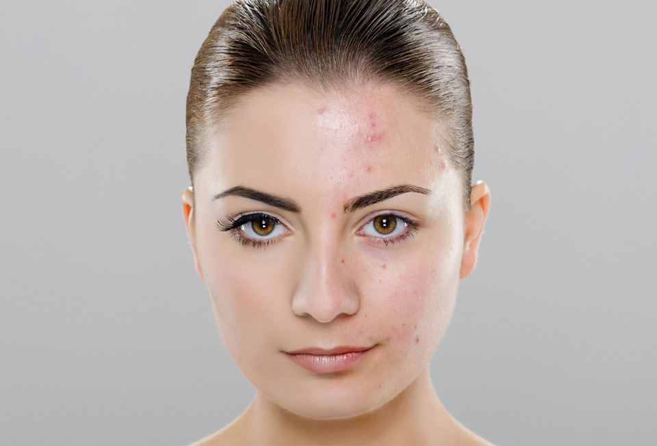 Specialized hair loss treatment for alopecia and pattern baldness in Kerala